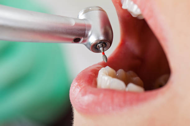 Best Emergency Dentist for Lost Fillings or Crowns in Rochester, NY